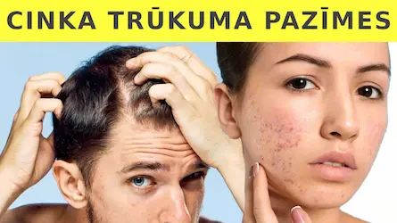 Cinka trūkuma pazīmes